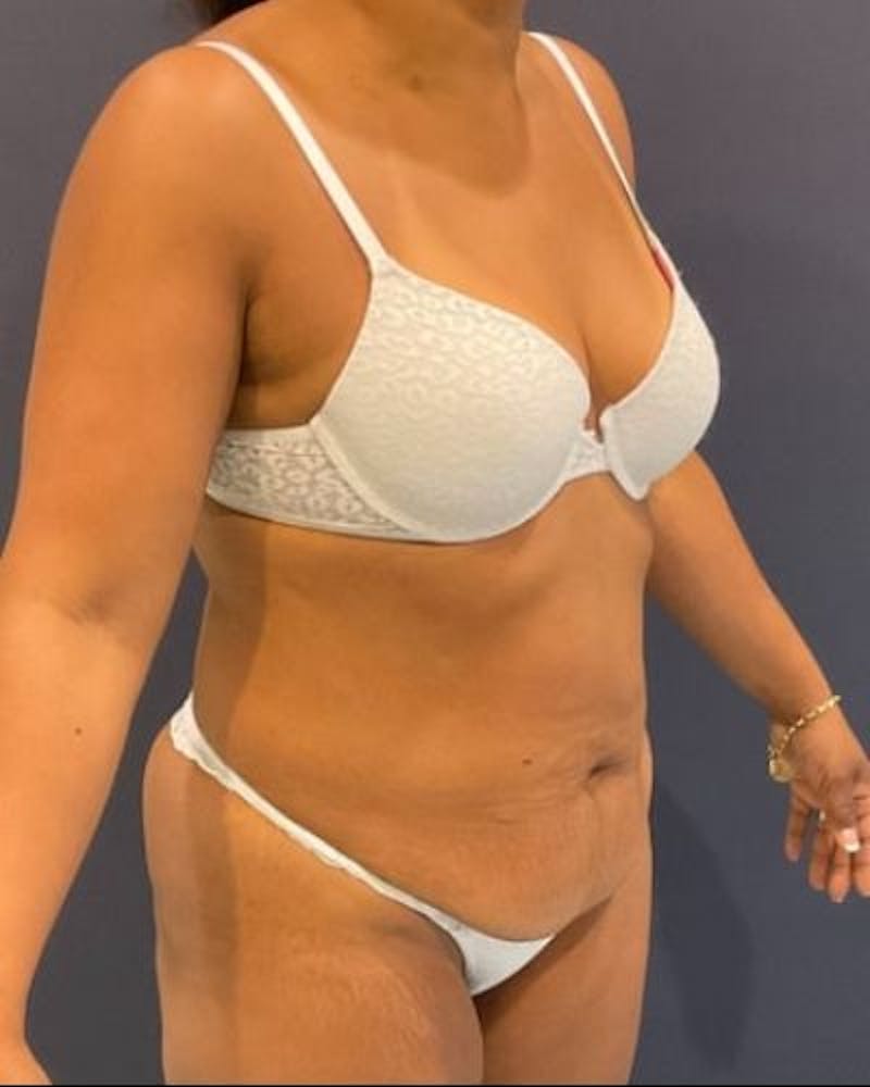 Tummy Tuck Before & After Gallery - Patient 307026 - Image 3