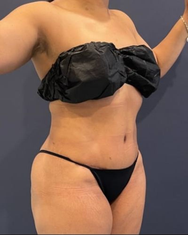 Tummy Tuck Before & After Gallery - Patient 307026 - Image 4