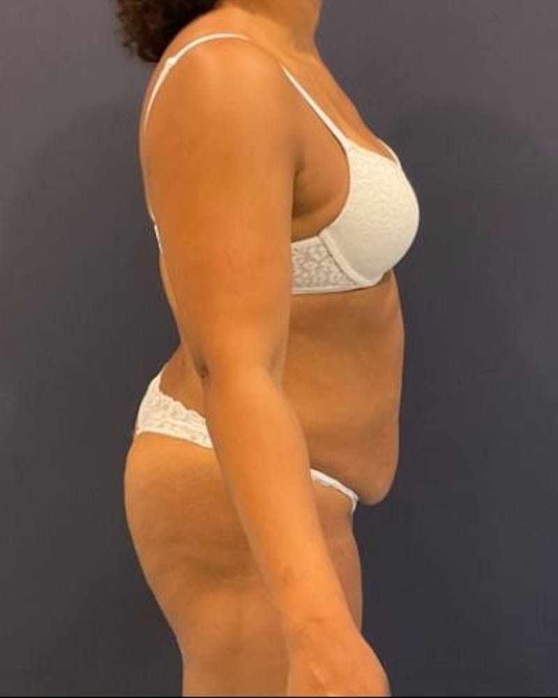 Tummy Tuck Before & After Gallery - Patient 307026 - Image 5