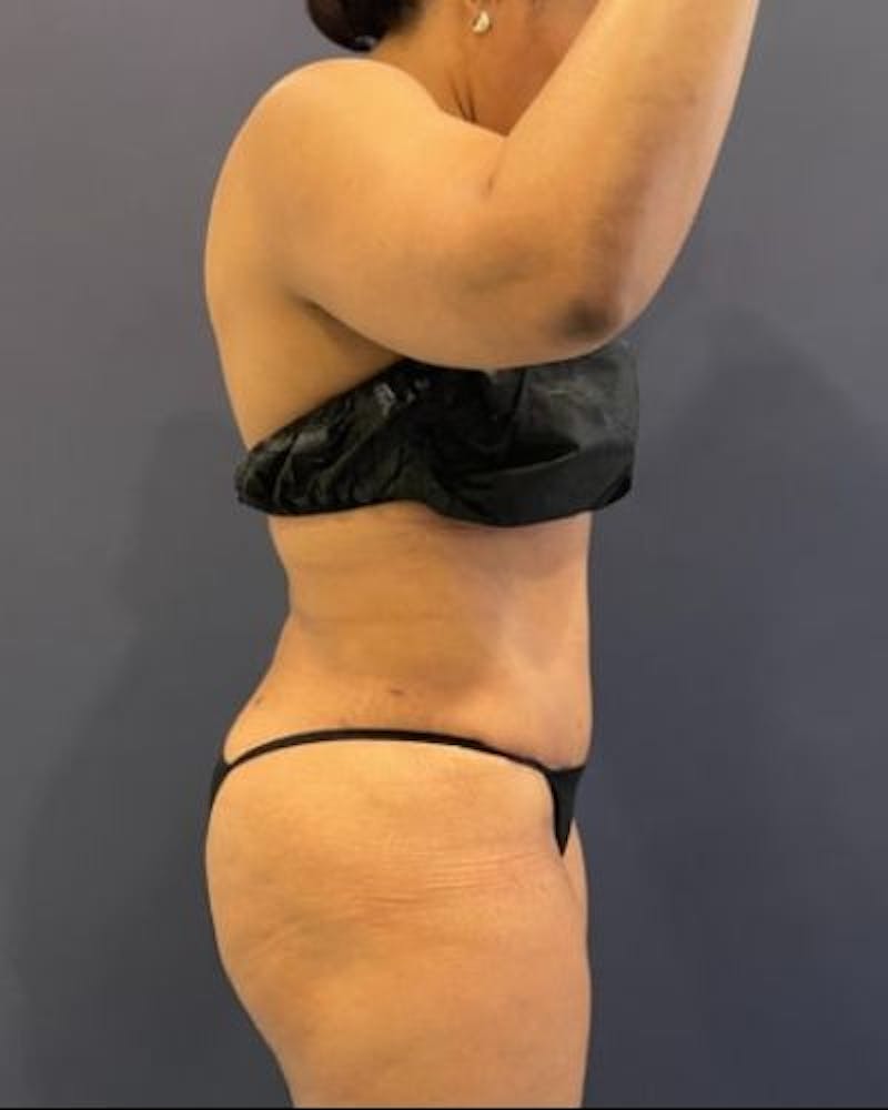 Tummy Tuck Before & After Gallery - Patient 307026 - Image 6