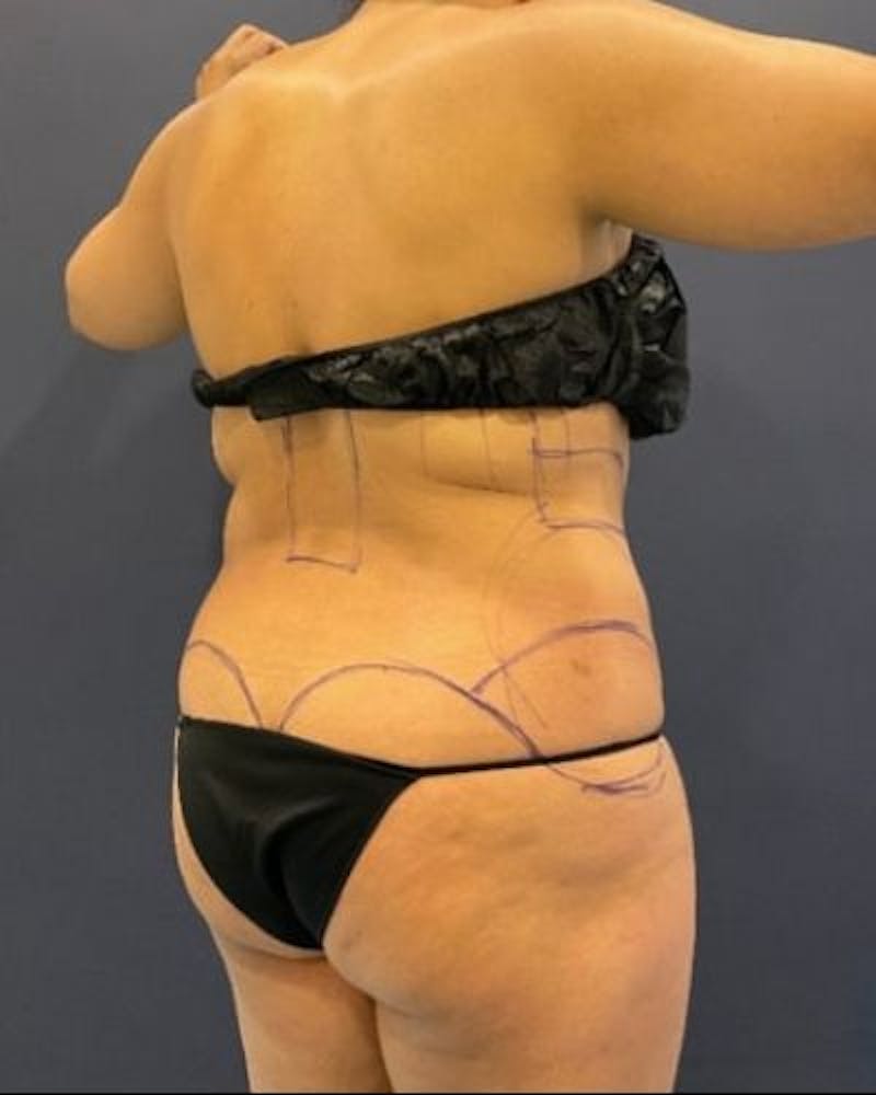 Tummy Tuck Before & After Gallery - Patient 307026 - Image 7
