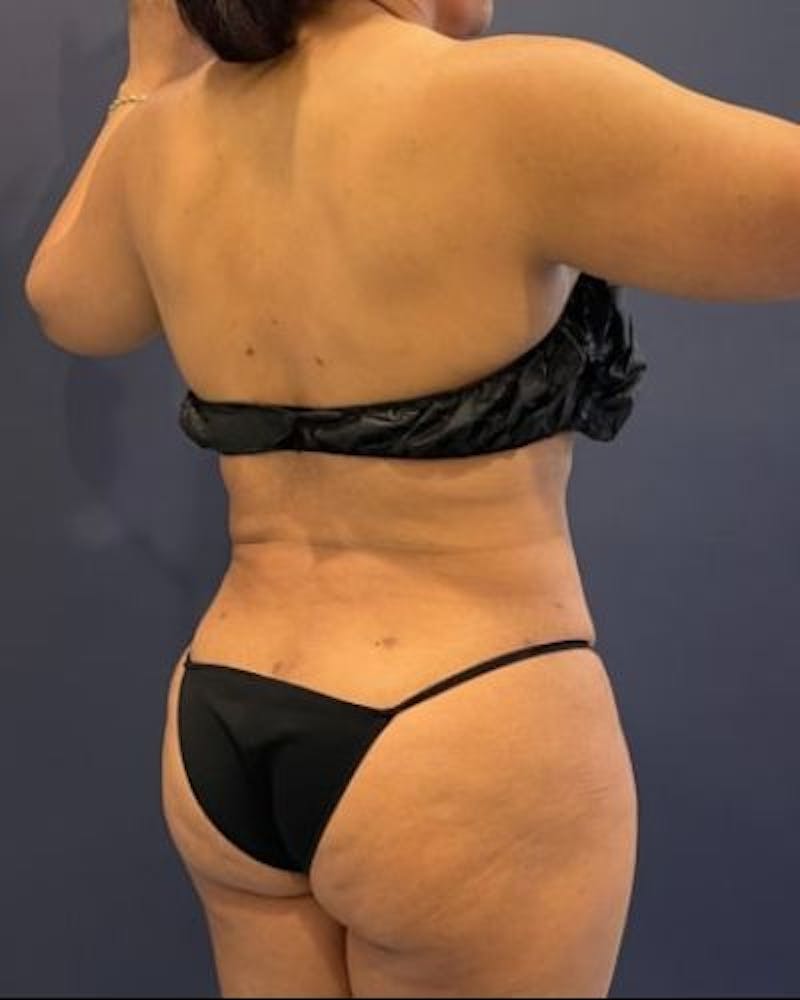 Tummy Tuck Before & After Gallery - Patient 307026 - Image 8