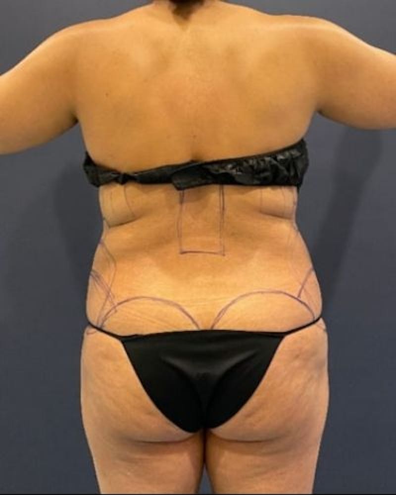 Tummy Tuck Before & After Gallery - Patient 307026 - Image 9