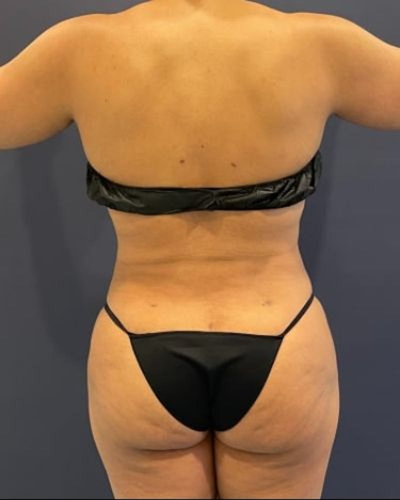 Tummy Tuck Before & After Gallery - Patient 307026 - Image 10