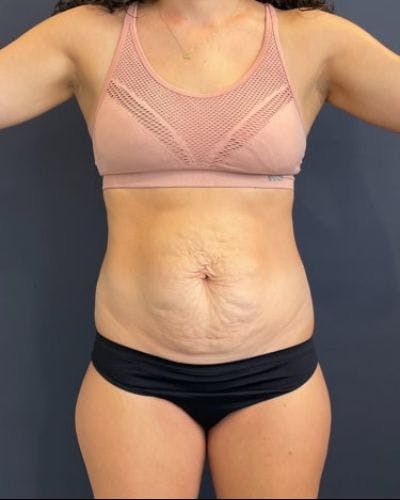 Tummy Tuck Before & After Gallery - Patient 302397 - Image 1