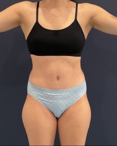 Tummy Tuck Before & After Gallery - Patient 302397 - Image 2