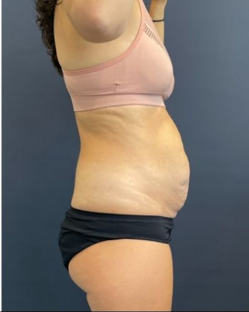 Tummy Tuck Before & After Gallery - Patient 302397 - Image 3