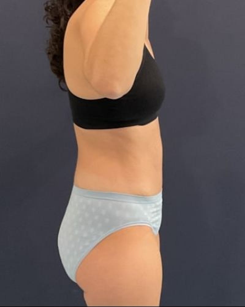 Tummy Tuck Before & After Gallery - Patient 302397 - Image 4