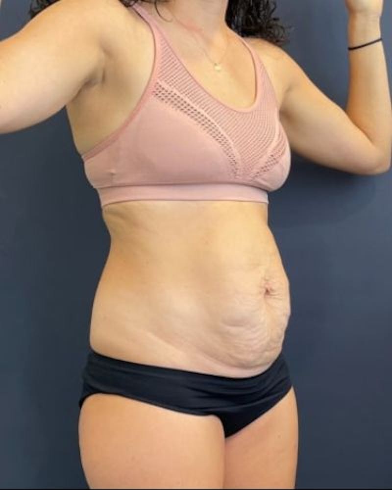 Tummy Tuck Before & After Gallery - Patient 302397 - Image 5