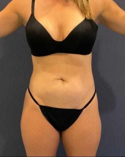 Tummy Tuck Before & After Gallery - Patient 315100 - Image 1