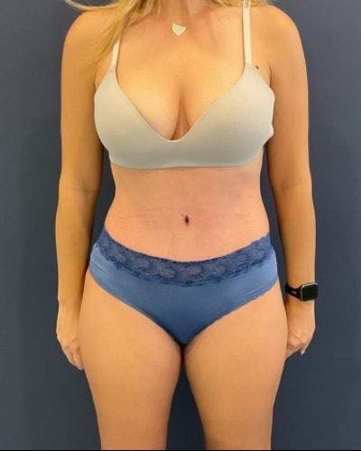 Tummy Tuck Before & After Gallery - Patient 315100 - Image 2