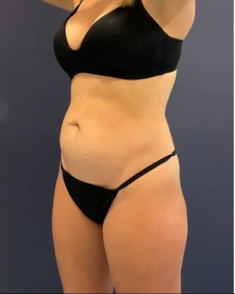 Tummy Tuck Before & After Gallery - Patient 315100 - Image 3