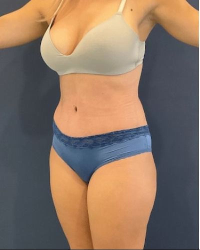 Tummy Tuck Before & After Gallery - Patient 315100 - Image 4