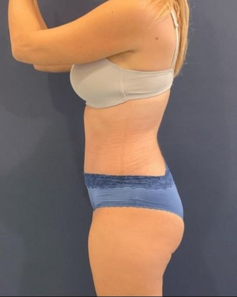Tummy Tuck Before & After Gallery - Patient 315100 - Image 6