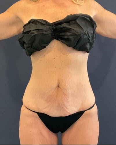 Tummy Tuck Before & After Gallery - Patient 460298 - Image 1