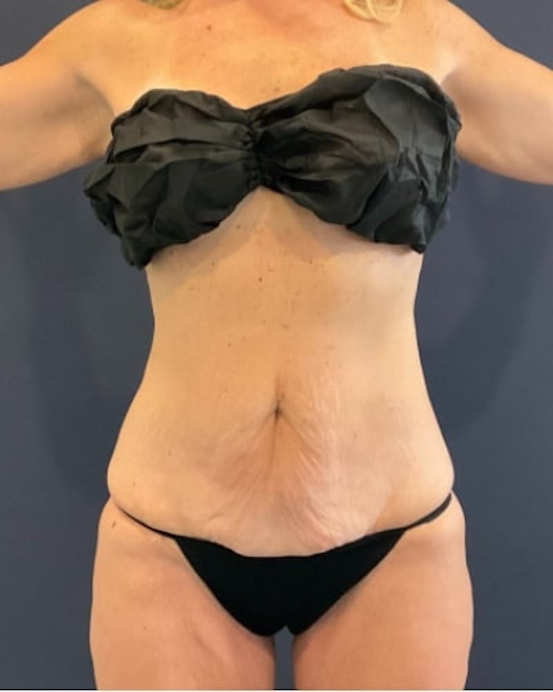 Tummy Tuck Before & After Gallery - Patient 460298 - Image 1