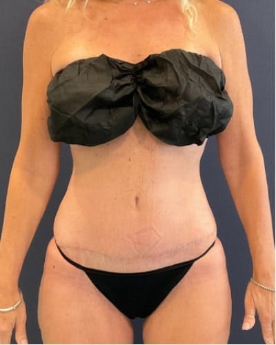 Tummy Tuck Before & After Gallery - Patient 460298 - Image 2