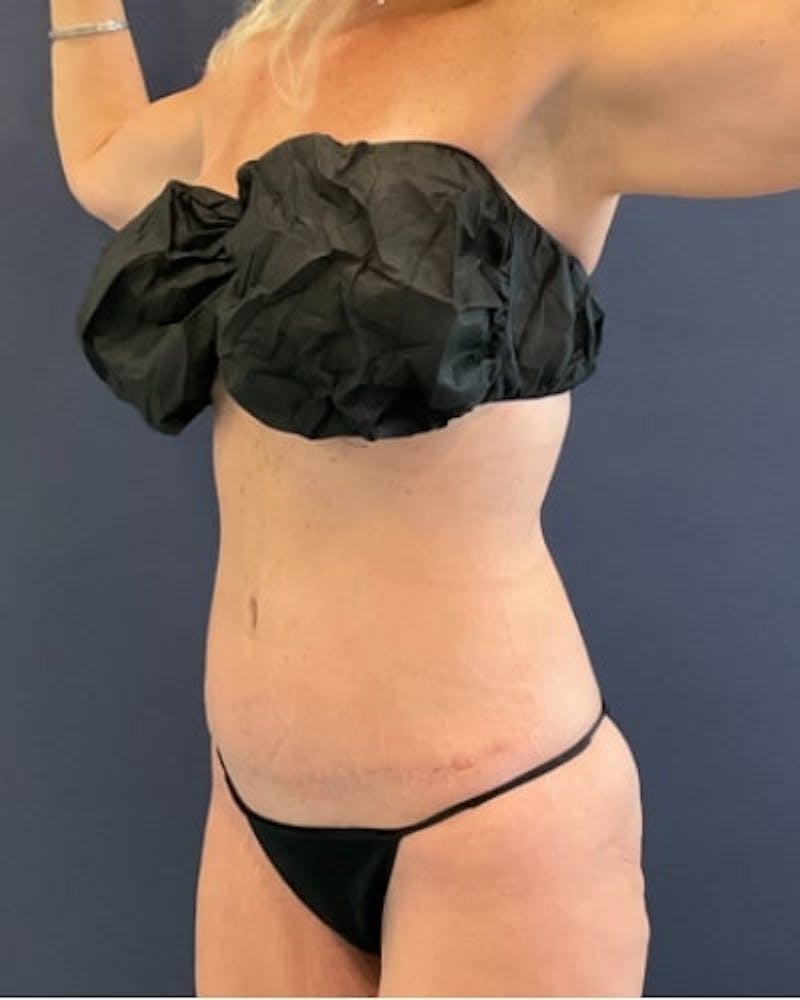 Tummy Tuck Before & After Gallery - Patient 460298 - Image 4