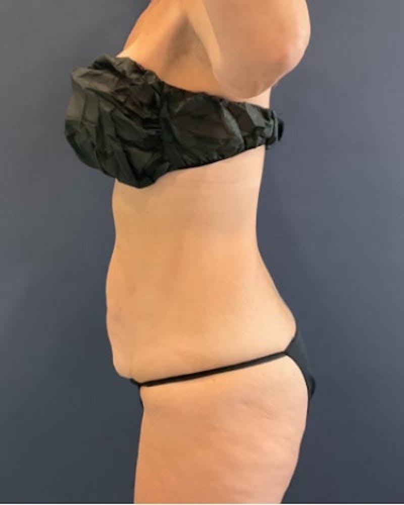 Tummy Tuck Before & After Gallery - Patient 460298 - Image 5