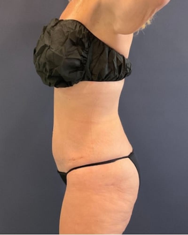Tummy Tuck Before & After Gallery - Patient 460298 - Image 6