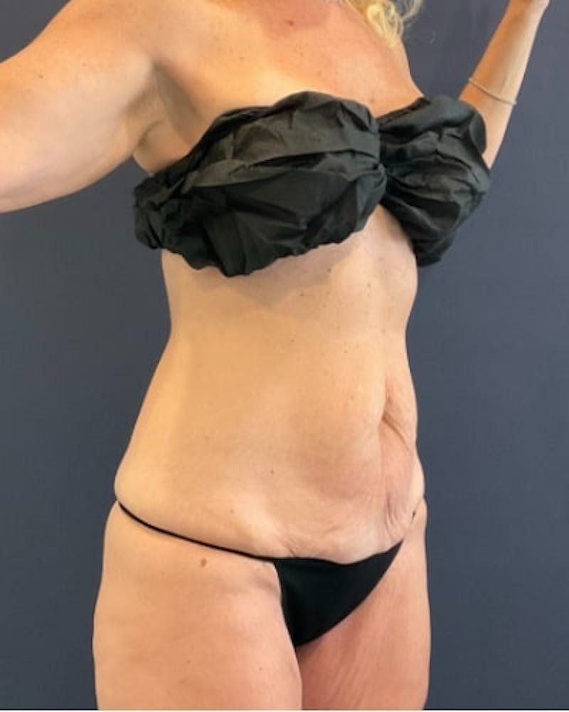 Tummy Tuck Before & After Gallery - Patient 460298 - Image 7