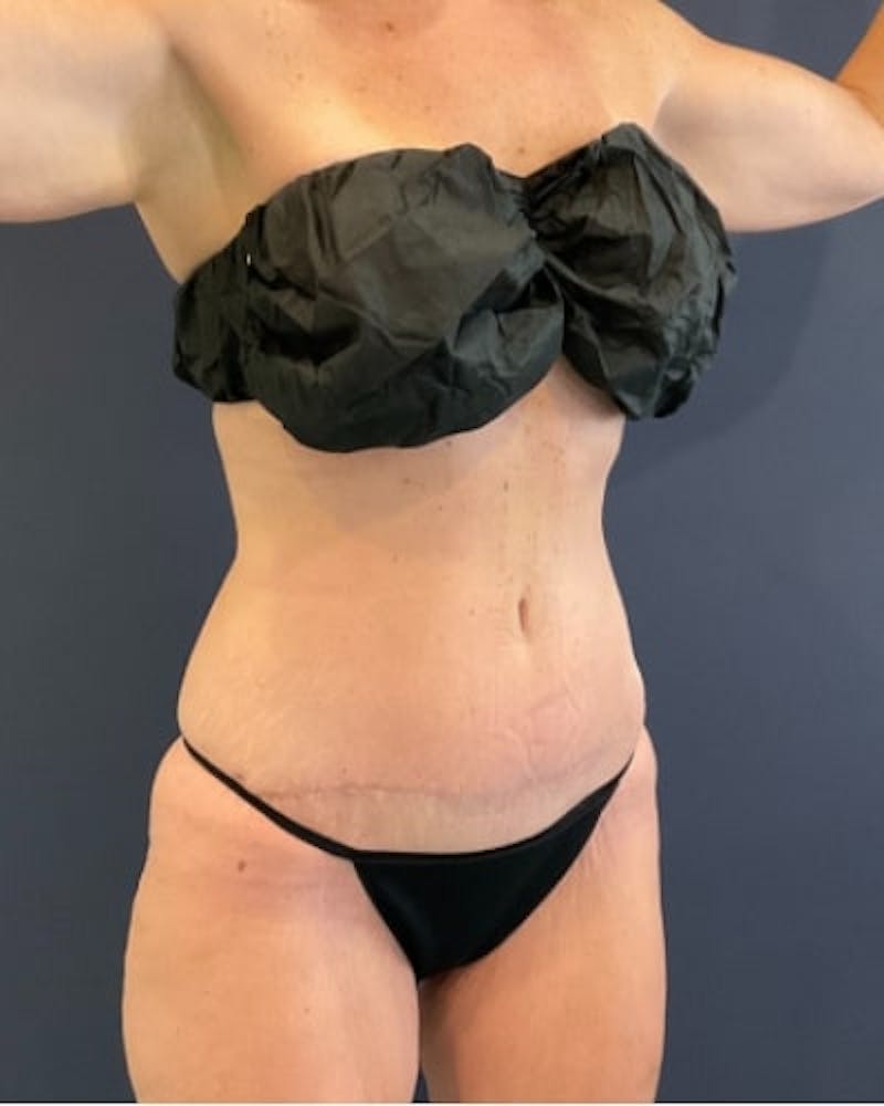 Tummy Tuck Before & After Gallery - Patient 460298 - Image 8