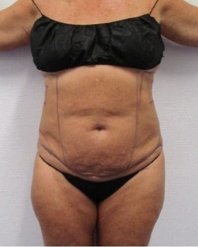 Tummy Tuck Before & After Gallery - Patient 391752 - Image 1