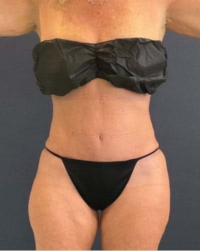 Tummy Tuck Before & After Gallery - Patient 391752 - Image 2