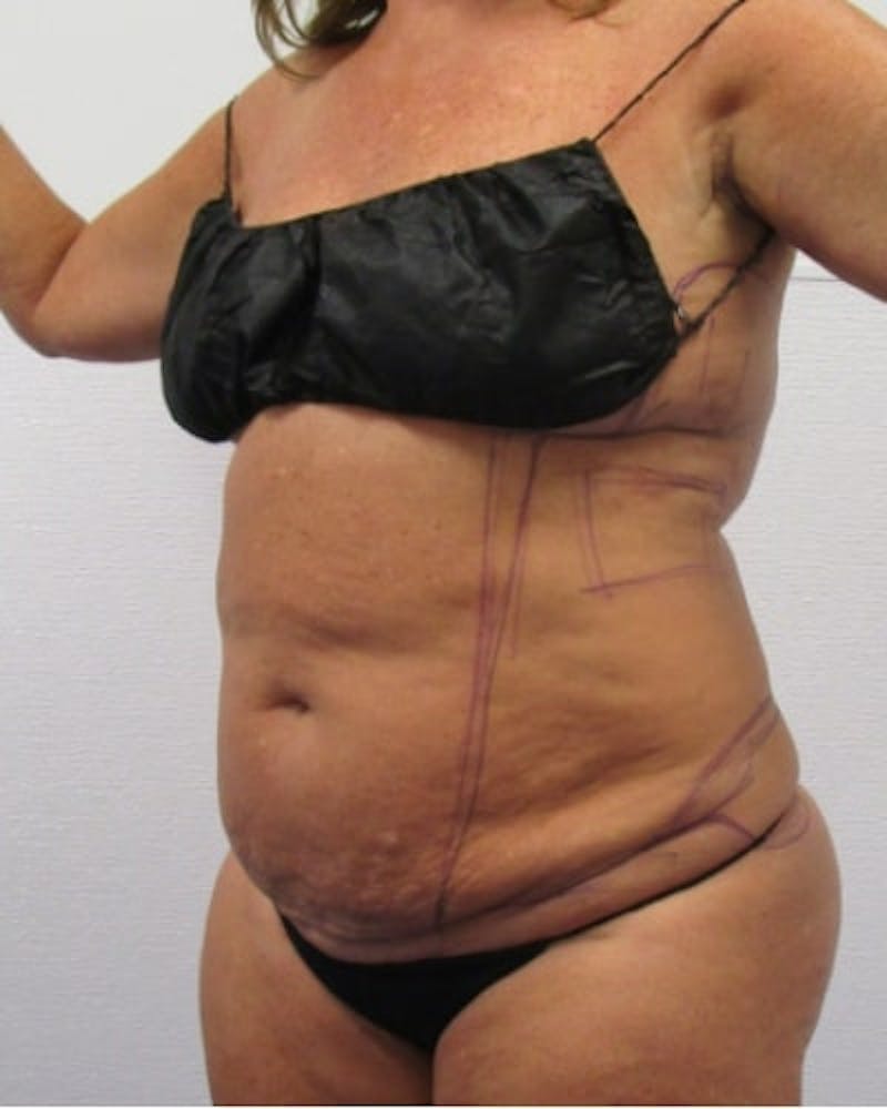 Tummy Tuck Before & After Gallery - Patient 391752 - Image 3