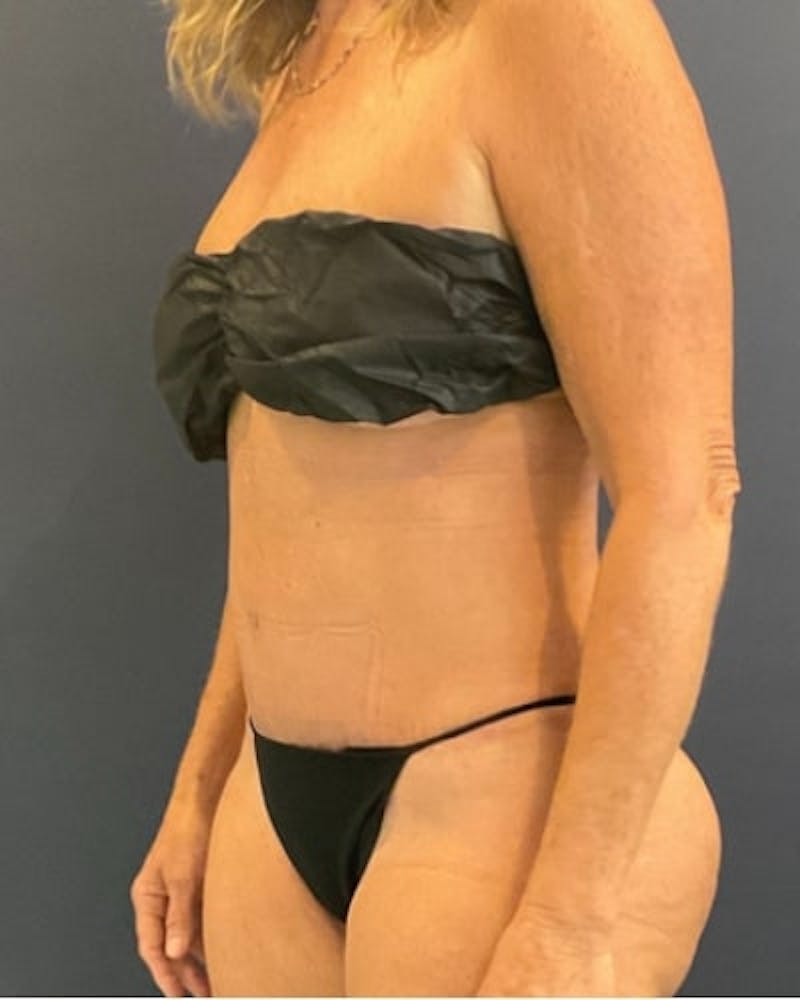 Tummy Tuck Before & After Gallery - Patient 391752 - Image 4