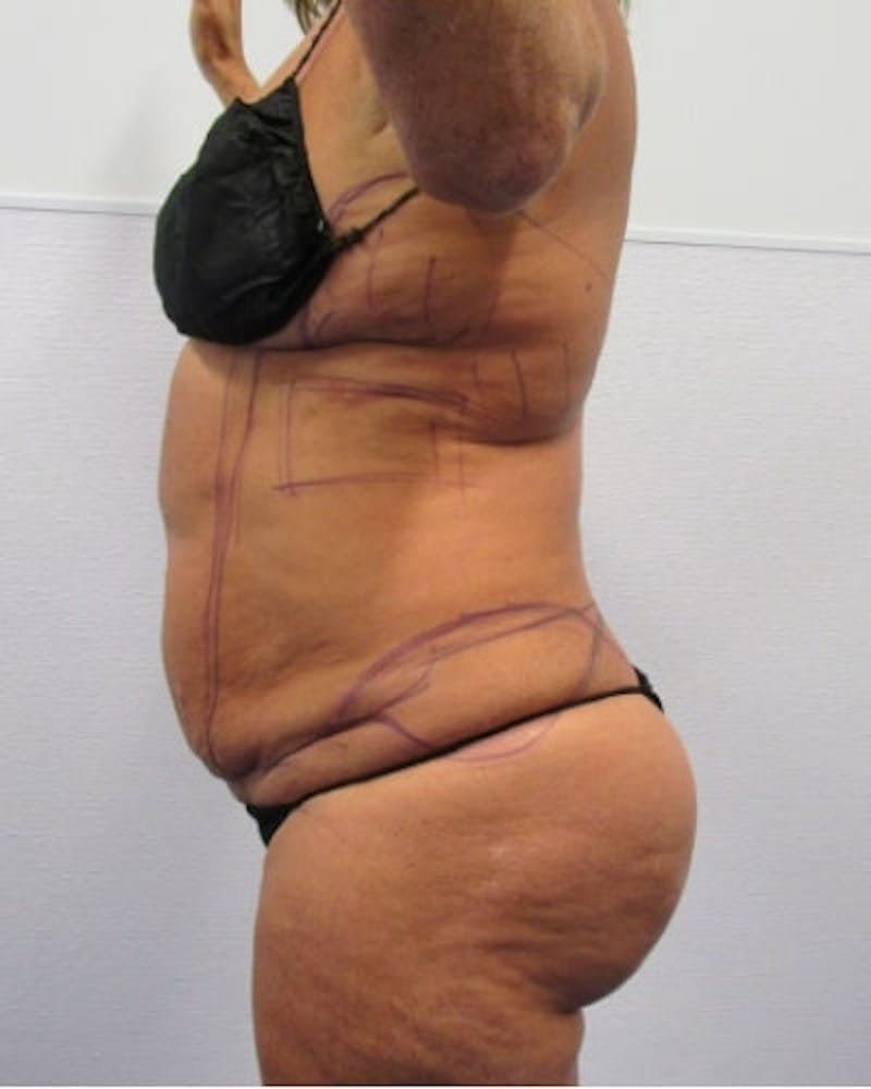 Tummy Tuck Before & After Gallery - Patient 391752 - Image 5