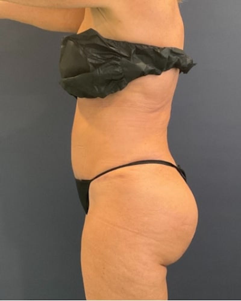 Tummy Tuck Before & After Gallery - Patient 391752 - Image 6