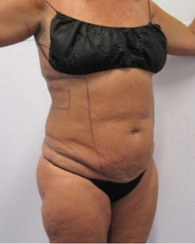 Tummy Tuck Before & After Gallery - Patient 391752 - Image 7
