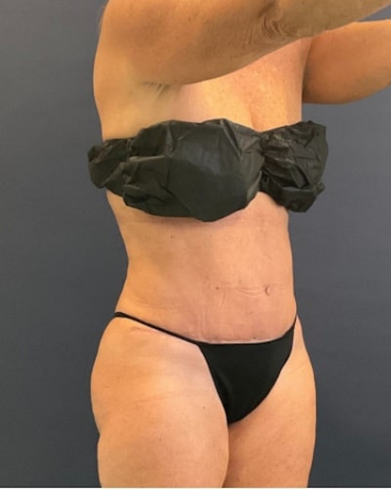 Tummy Tuck Before & After Gallery - Patient 391752 - Image 8