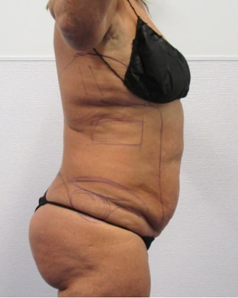 Tummy Tuck Before & After Gallery - Patient 391752 - Image 9