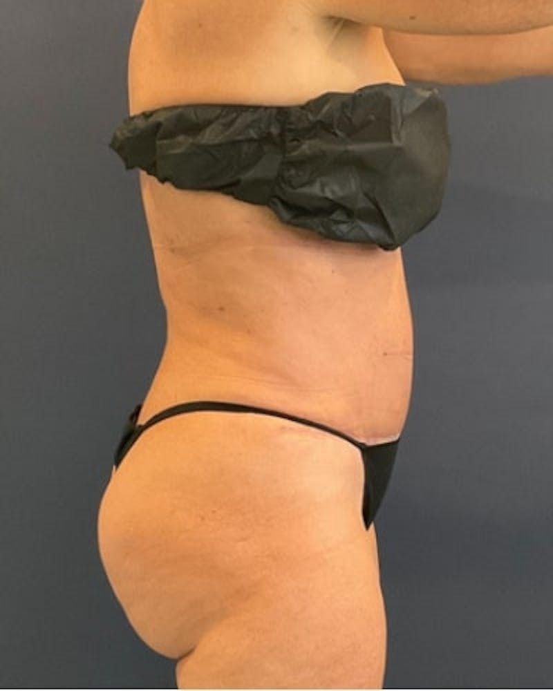 Tummy Tuck Before & After Gallery - Patient 391752 - Image 10