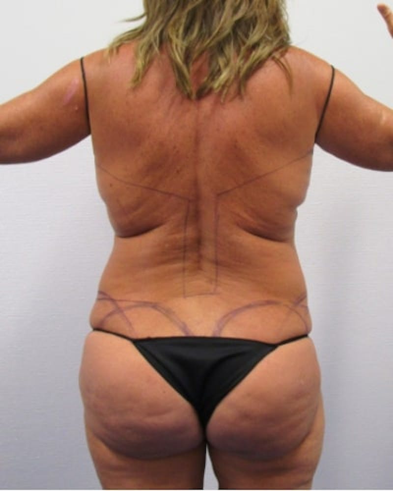 Tummy Tuck Before & After Gallery - Patient 391752 - Image 11