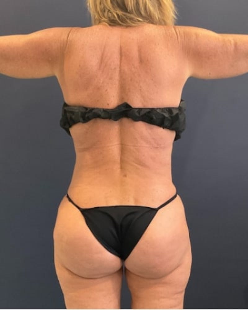 Tummy Tuck Before & After Gallery - Patient 391752 - Image 12