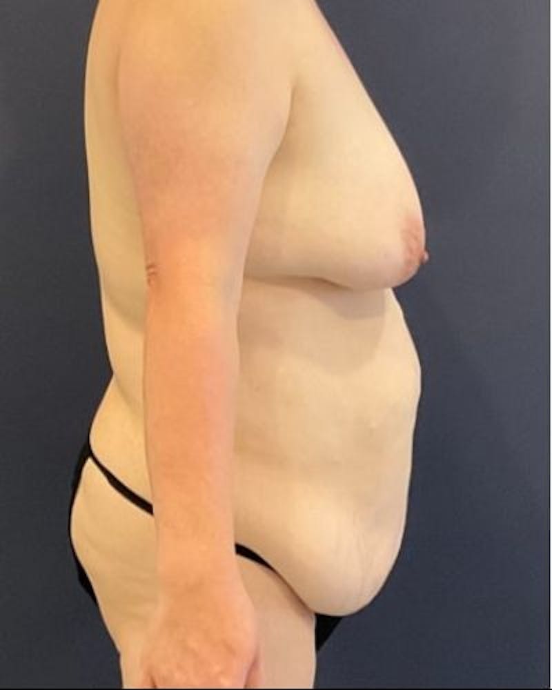 Tummy Tuck Before & After Gallery - Patient 259203 - Image 1