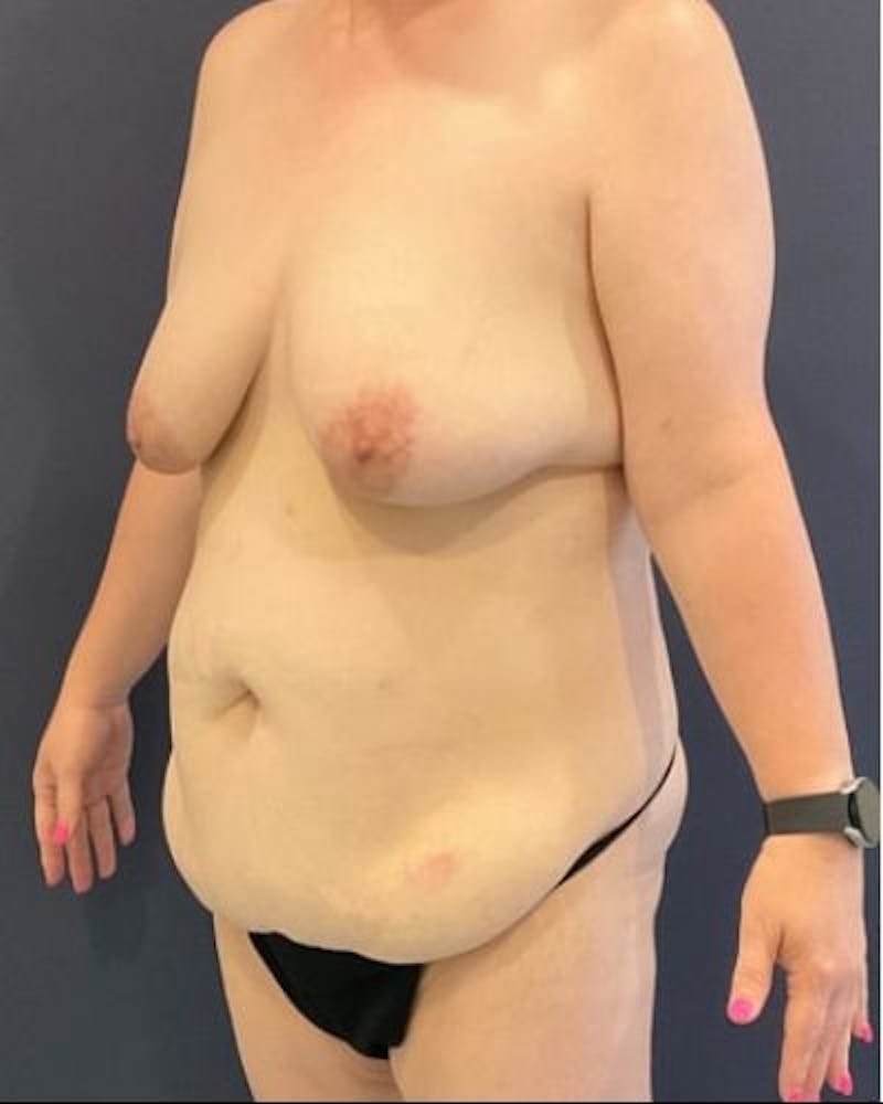 Tummy Tuck Before & After Gallery - Patient 259203 - Image 3