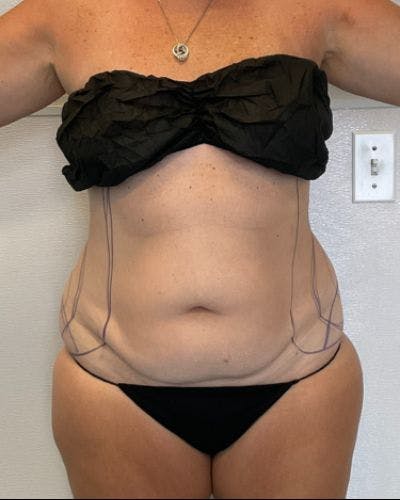 Tummy Tuck Before & After Gallery - Patient 236846 - Image 1