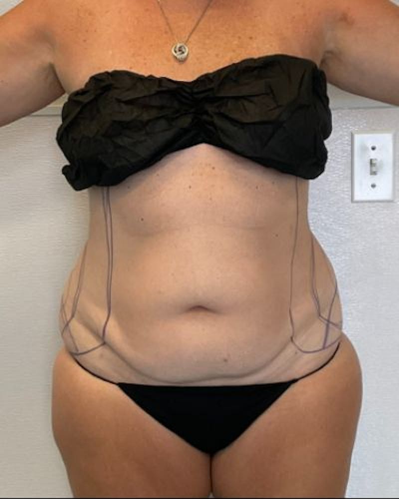 Tummy Tuck Before & After Gallery - Patient 236846 - Image 1