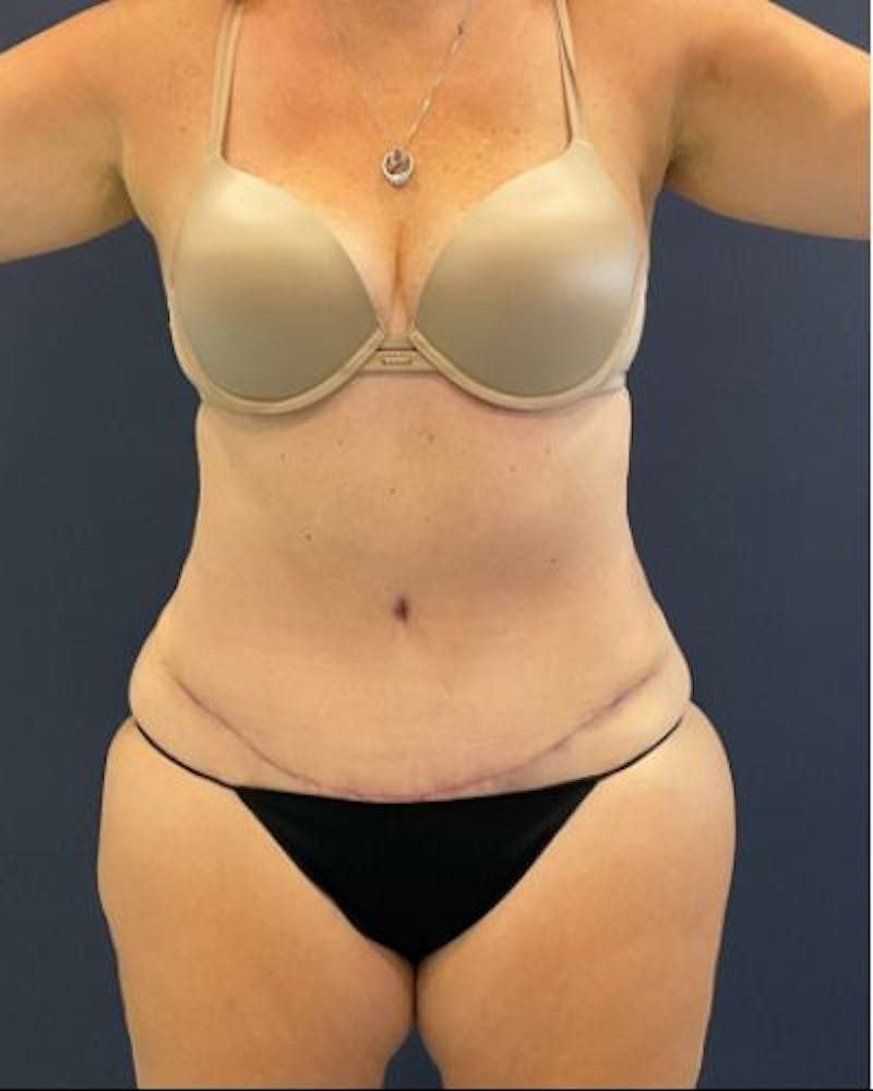 Tummy Tuck Before & After Gallery - Patient 236846 - Image 2