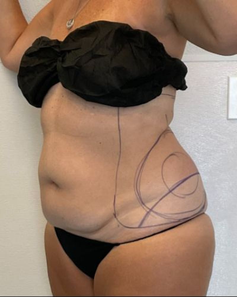 Tummy Tuck Before & After Gallery - Patient 236846 - Image 3