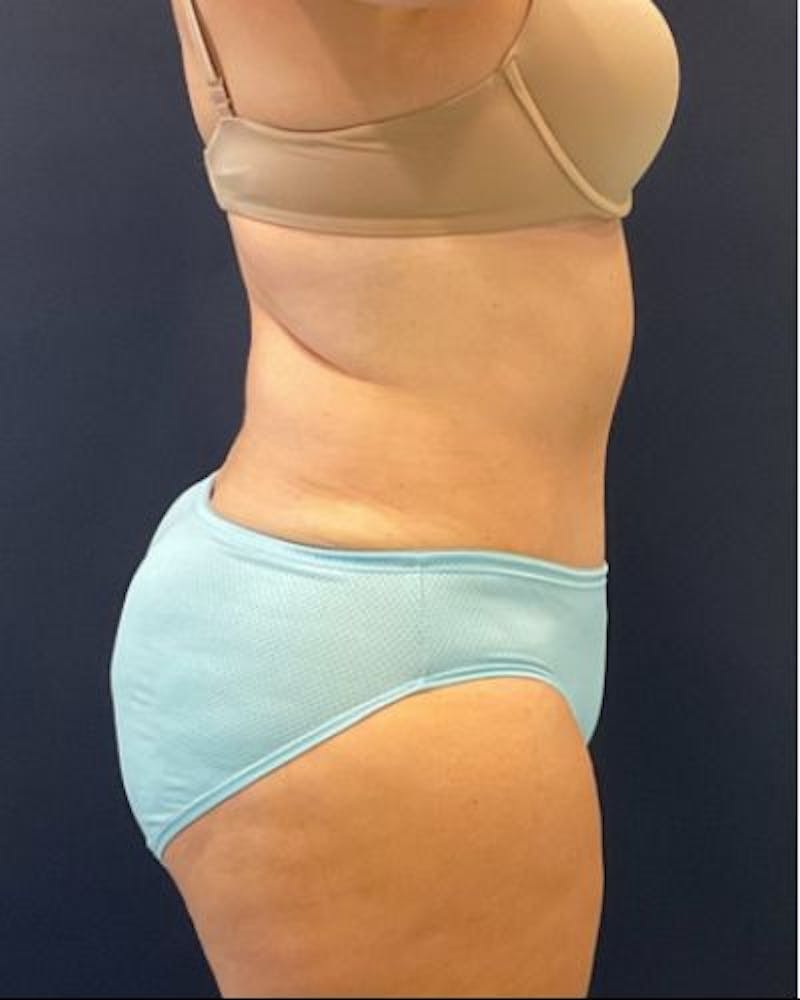 Tummy Tuck Before & After Gallery - Patient 236846 - Image 6