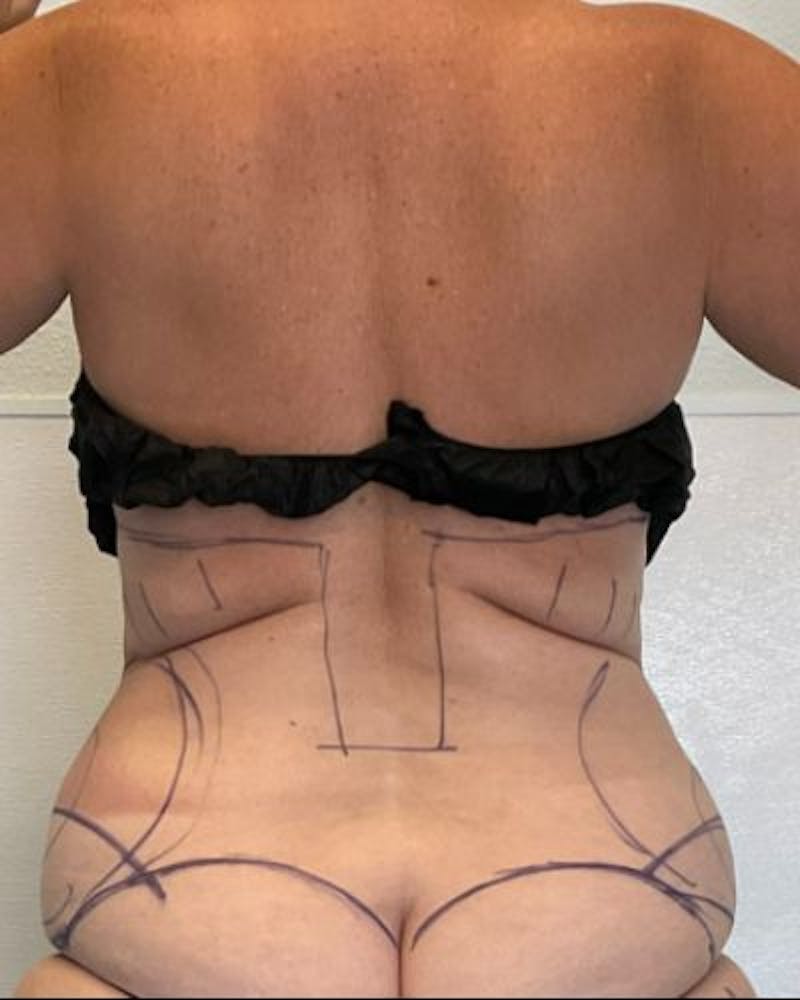 Tummy Tuck Before & After Gallery - Patient 236846 - Image 7