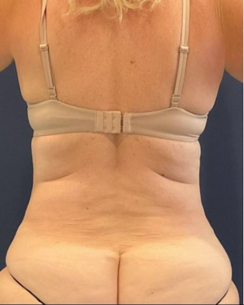 Tummy Tuck Before & After Gallery - Patient 236846 - Image 8