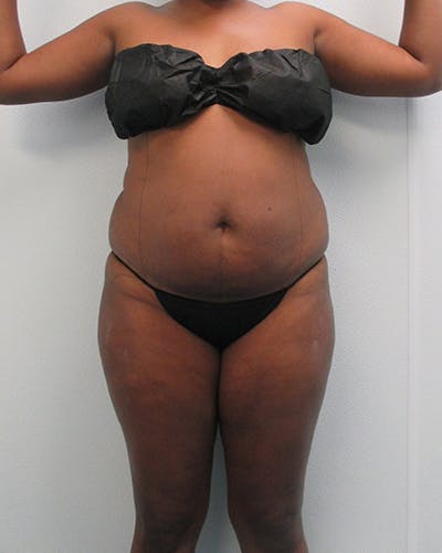 Tummy Tuck Before & After Gallery - Patient 105430 - Image 1