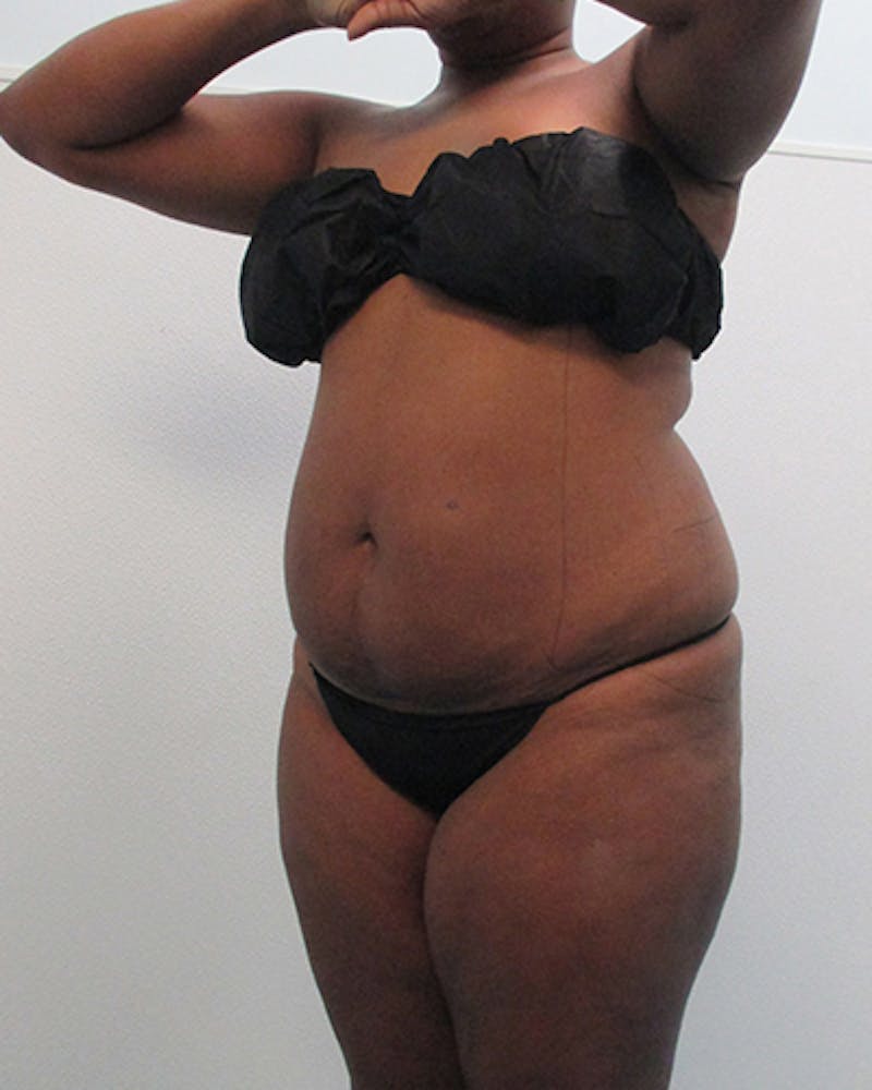 Tummy Tuck Before & After Gallery - Patient 105430 - Image 3