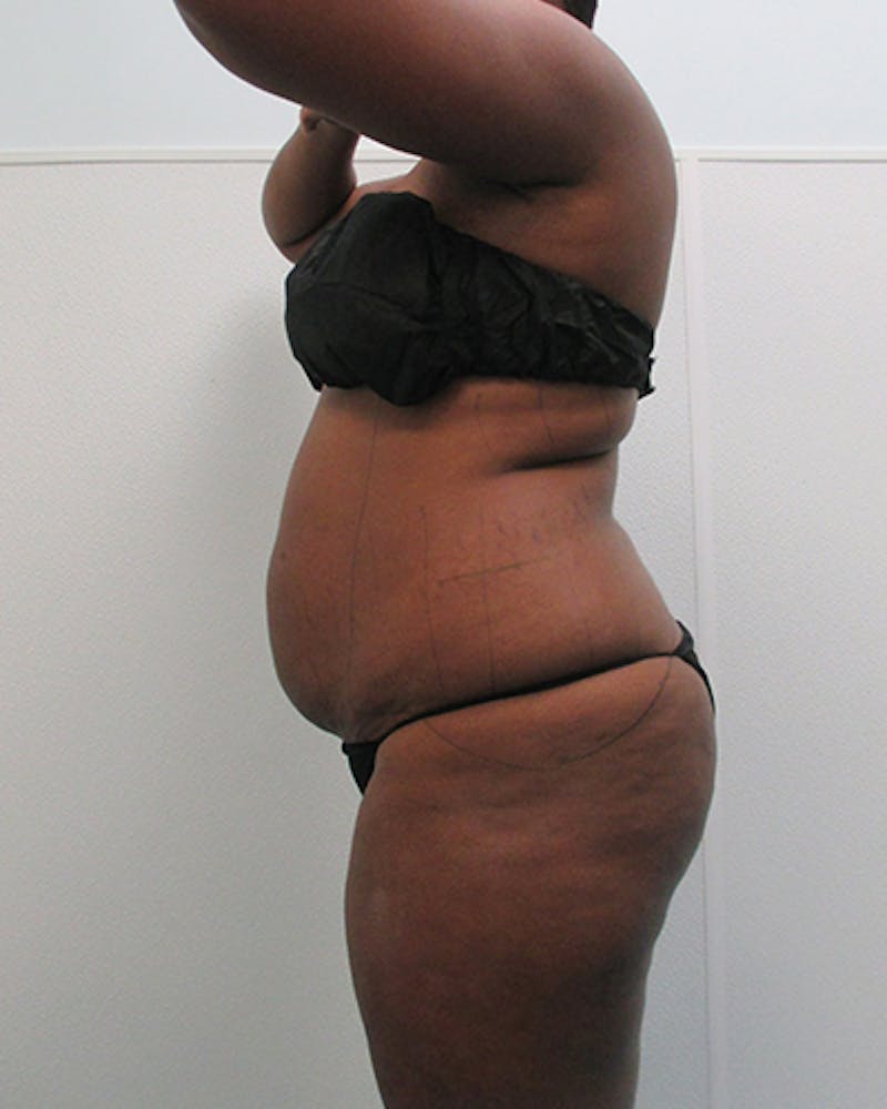 Tummy Tuck Before & After Gallery - Patient 105430 - Image 5